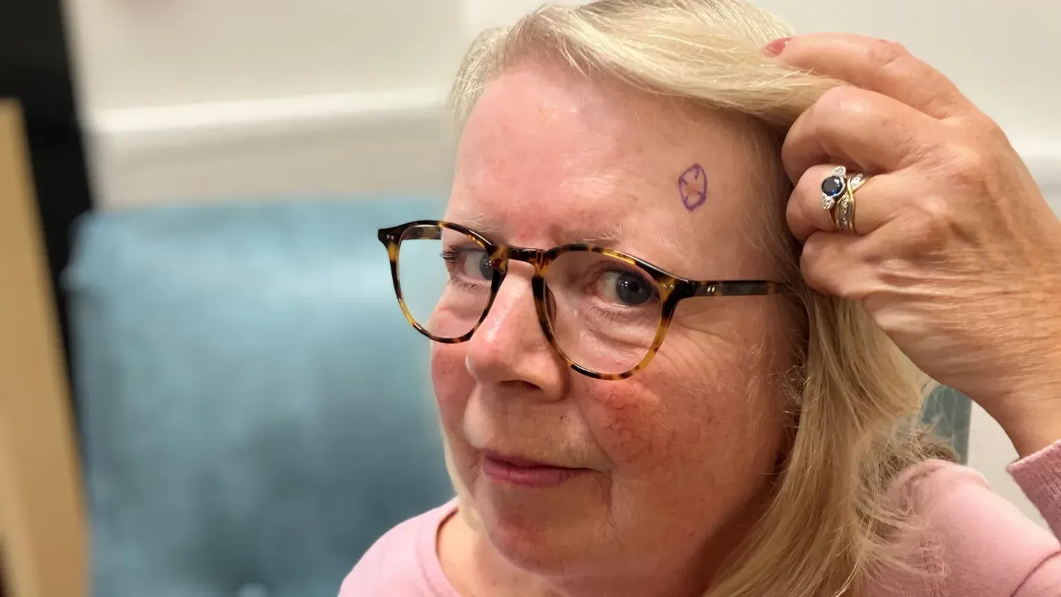 NHS rolls out skin cancer AI across 18 trusts