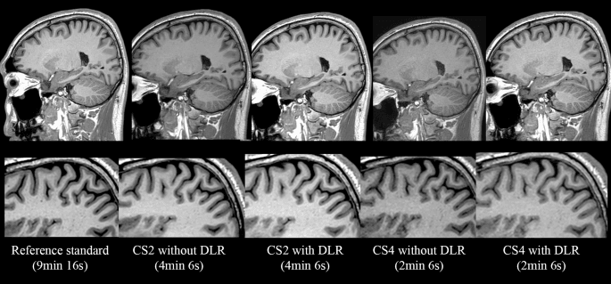 Algorithms can make MRI scans sharper while subtly shifting clinical data