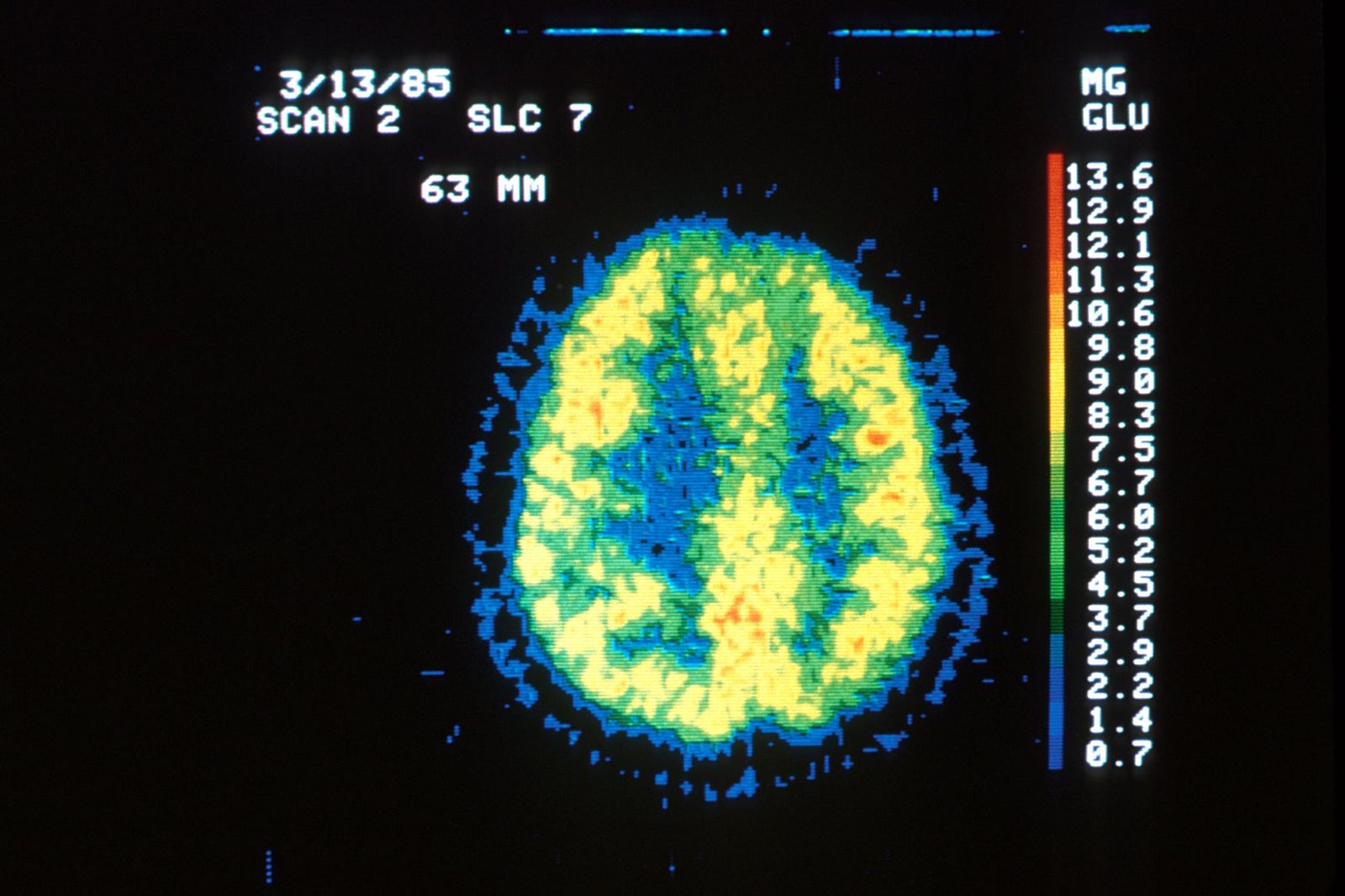 A color-coded brain scan shows varying glucose uptake across hemispheres, reflecting distinct metabolic demands.