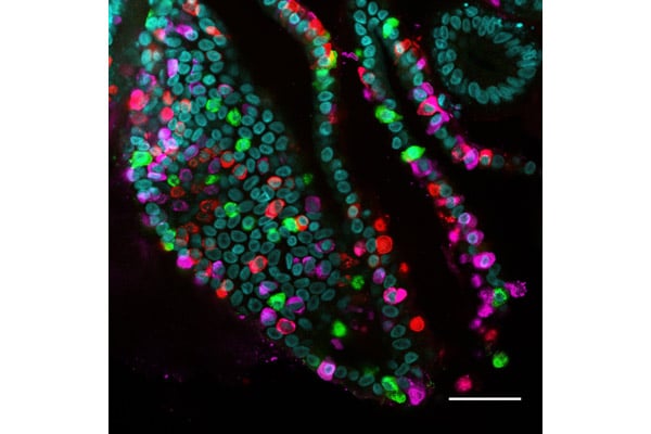 Experimental triple hormone drug reduces body weight in diabetes trial