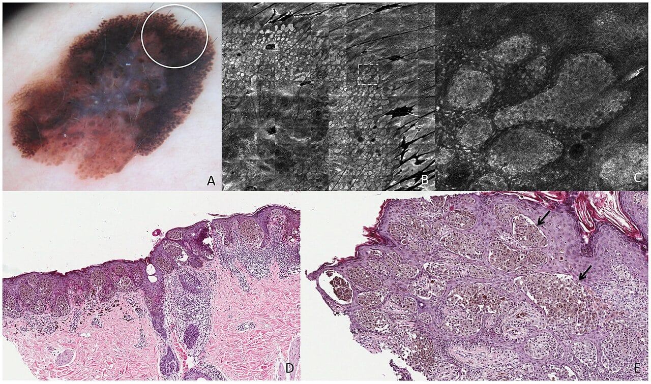 Cancer and neurodegeneration reveal an uneasy biological trade-off
