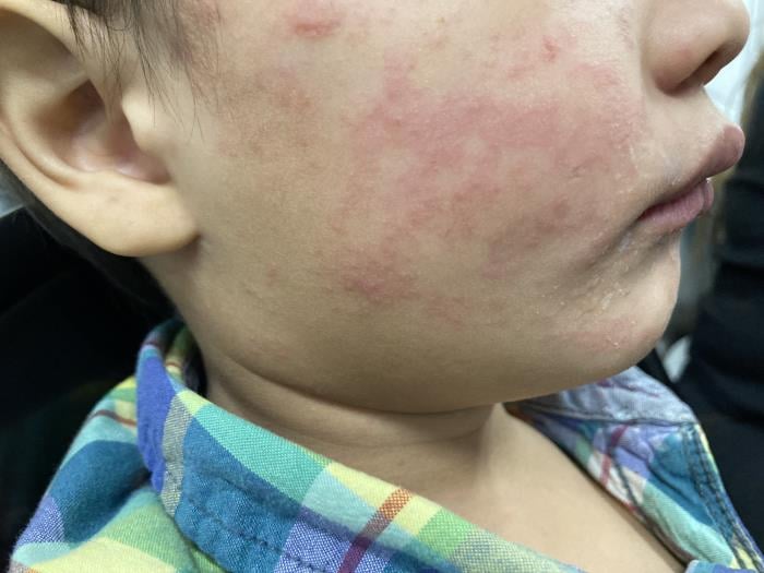 Pennsylvania measles outbreak exceeds 1,000 confirmed cases