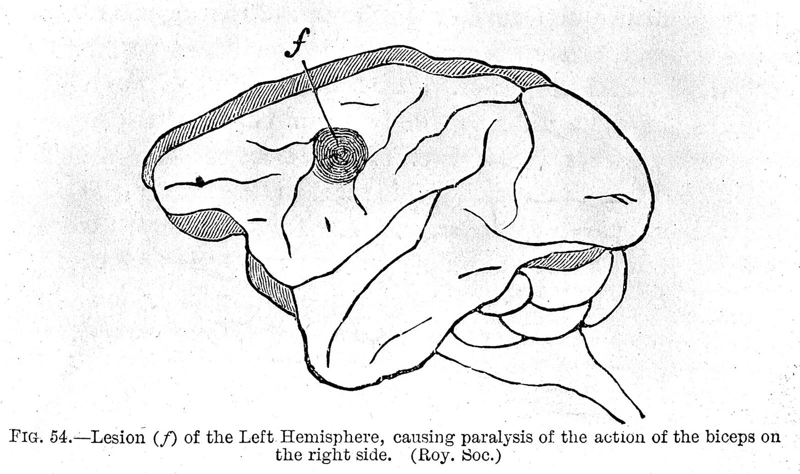 Brain side matters in animal models of neurological disease