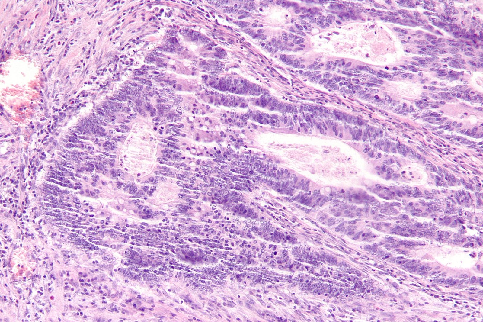 Why colorectal cancer in young adults is proving so dangerous